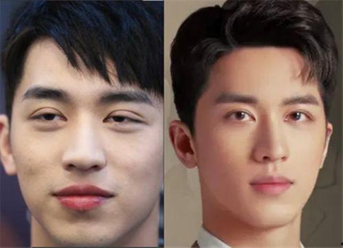 明星整双眼皮,双眼皮整形术的蜕变之路