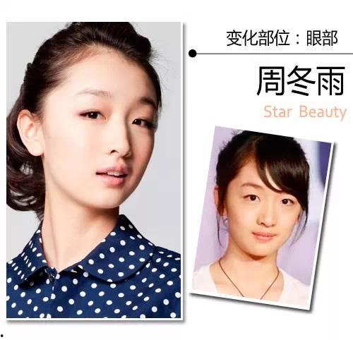 明星整双眼皮,双眼皮整形术的蜕变之路  第2张