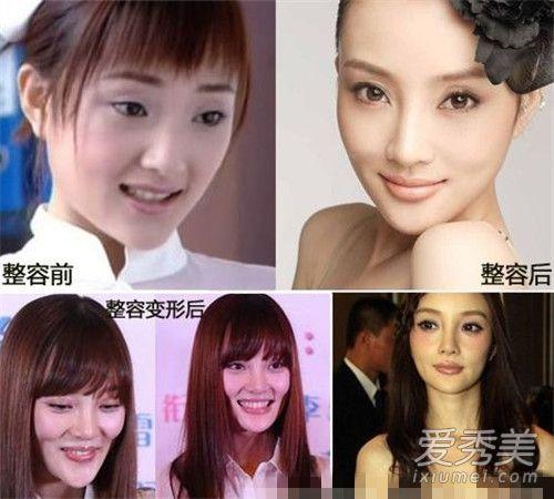 明星整双眼皮,双眼皮整形术的蜕变之路  第3张