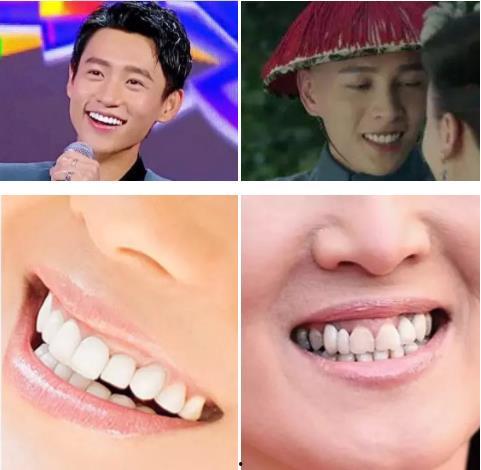 明星都是做的烤瓷牙吗
