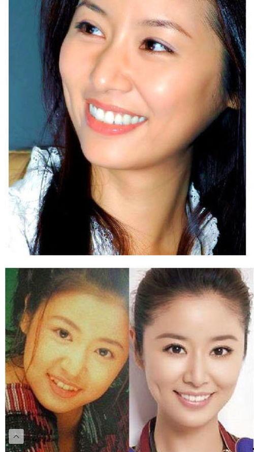 明星都是做的烤瓷牙吗  第2张